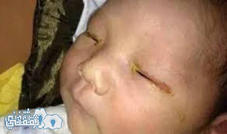 هذا الطفل عمره ثلاثة أشهر فقد بصره .والسبب نفعله كلنا دون أن ننتبه له!