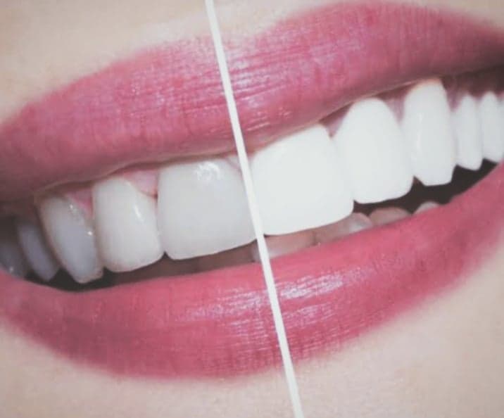 خلطات تبييض الأسنان وطريقة ازالة الجير من الاسنان