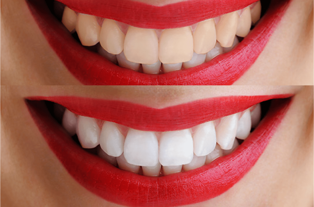 تبييض الأسنان باستخدام بعض الخلطات الطبيعية للتخلص من اصفرار الأسنان في المنزل
