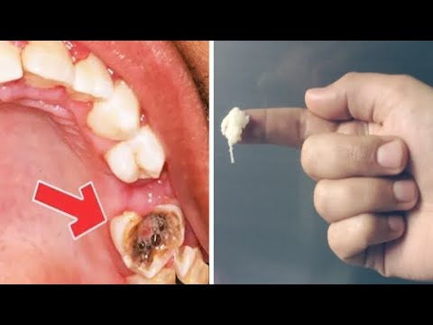 الحل الفعال لعلاج تسوس الاسنان الذى يخفيه الأطباء