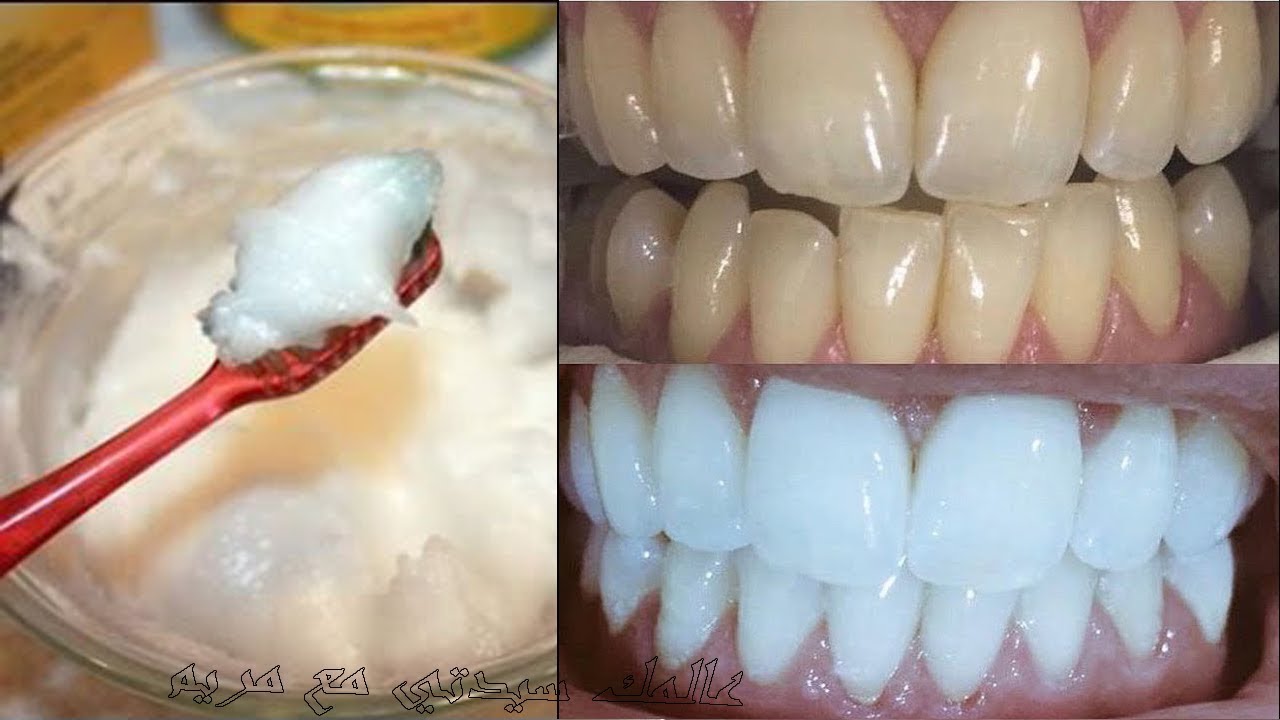 إزالة الرواسب الجيرية من الأسنان بوصفة منزلية والنتيجة مذهلة من أول مرة