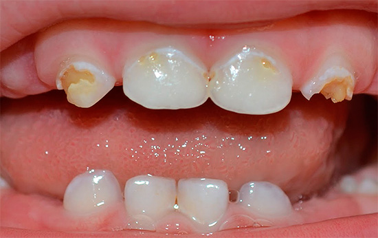 أفضل علاج منزلي طبيعي للتخلص من تسوس الأسنان عند الأطفال