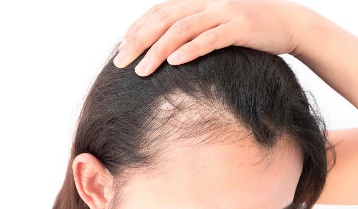 أسباب تساقط الشعر للسيدات و طرق طبيعيه لعلاج