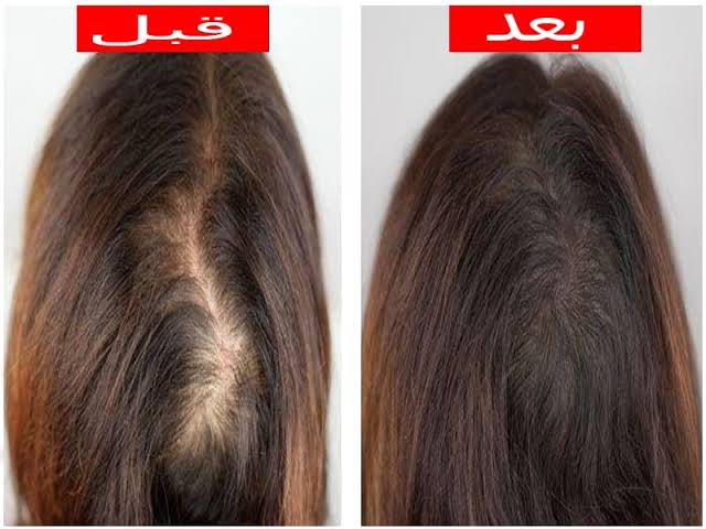 أسباب تساقط الشعر من الجذور وطرق علاجه بمواد طبيعية