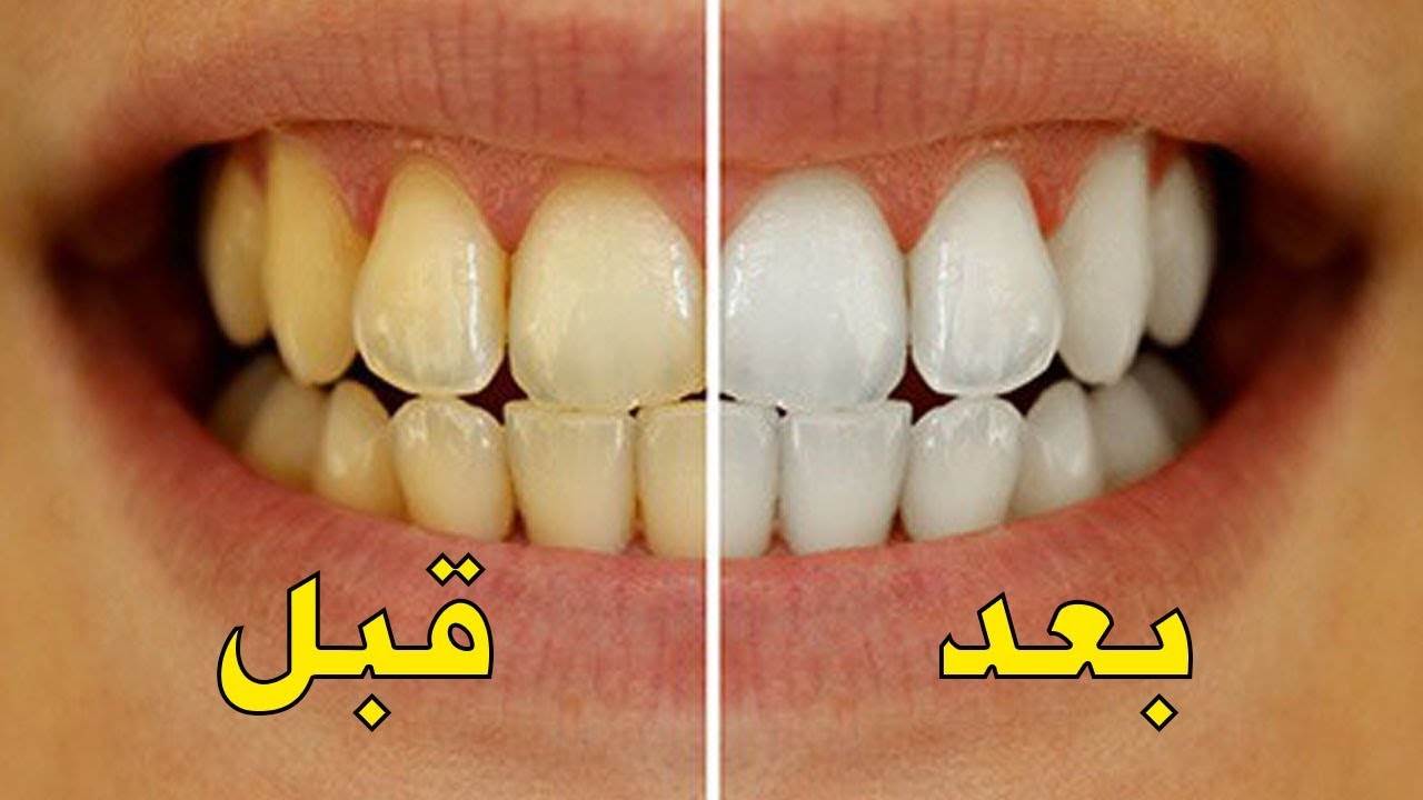 وصفة لتبييض الأسنان في يوم واحد بمكونات طبيعية وآمنة 100%