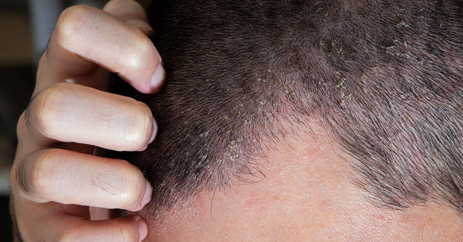 علاج صدفية الشعر في المنزل بمكونات طبيعية