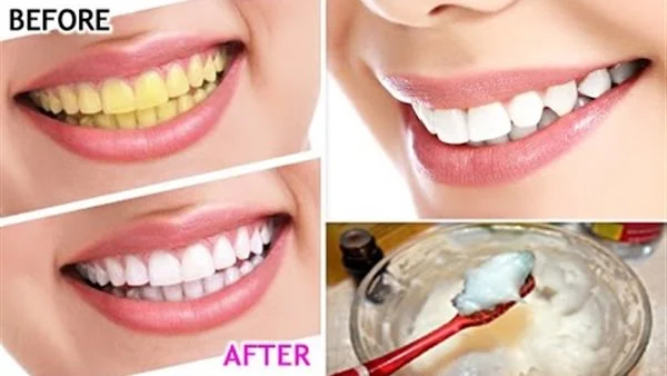 أنقذ اسنانك من الضياع خلطة تبيض الأسنان كالؤلؤ وإزالة الجير والاصفرار نهائيا من أول استخدام