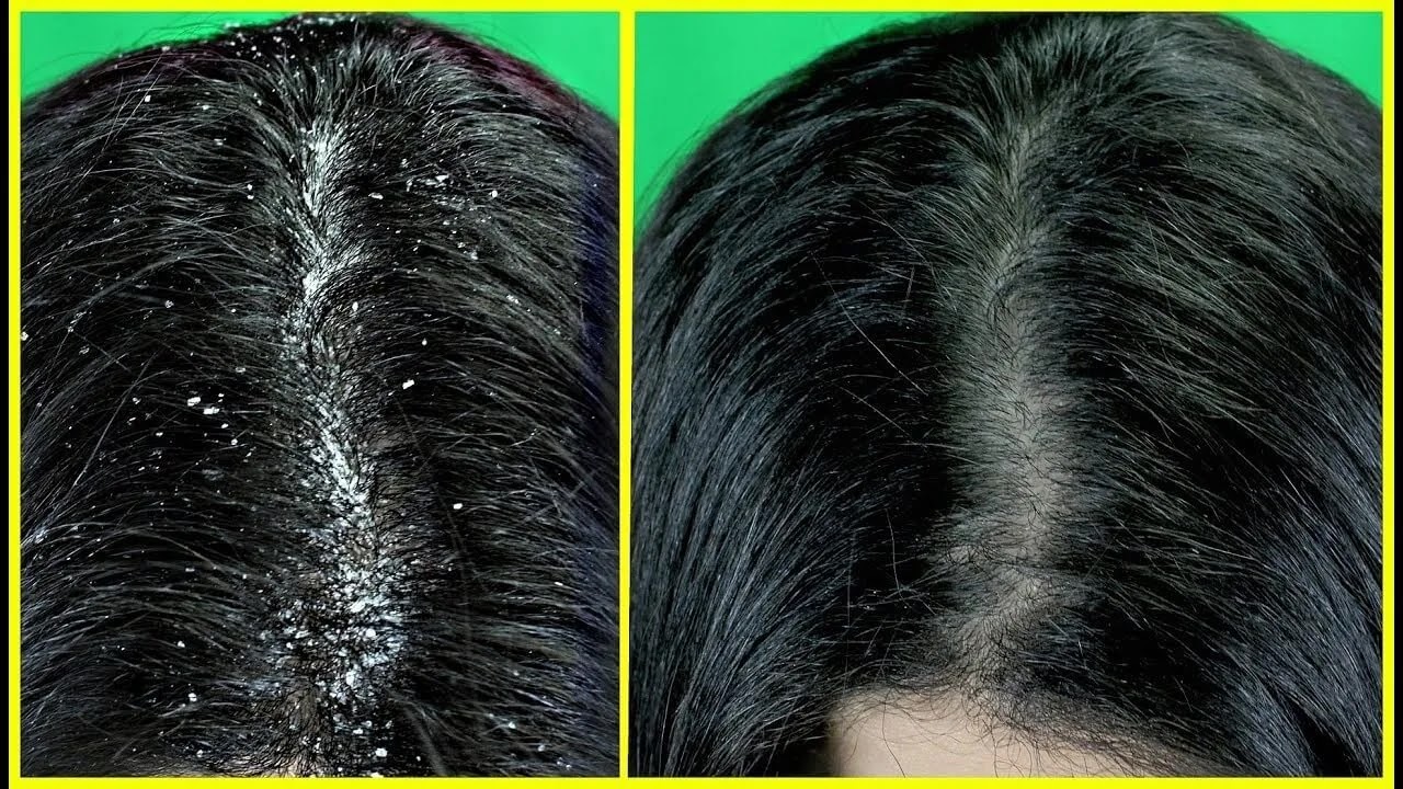 الحل النهائي للتخلص من قشرة الشعر بوصفات فعالة