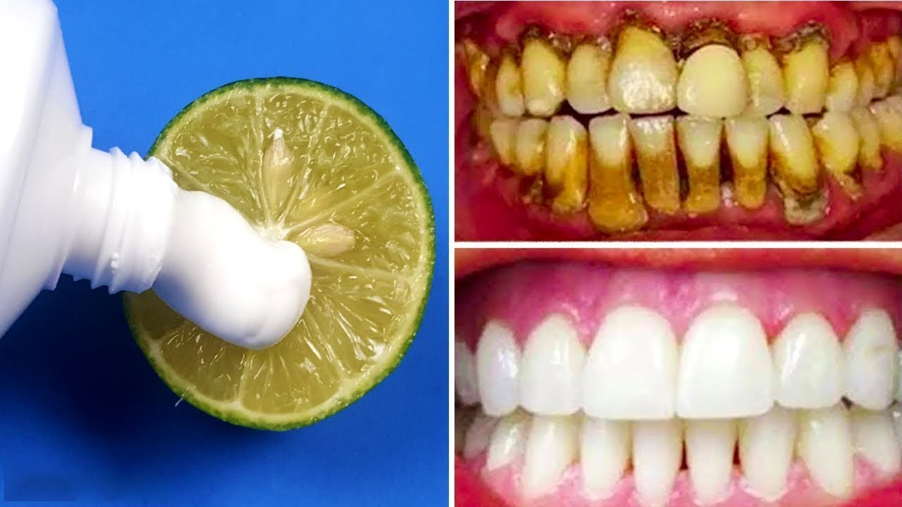 أنقذ أسنانك من التسوس.. تبيض الأسنان في 3 دقائق وإزالة الجير والأصفرار أقوي من الليزر