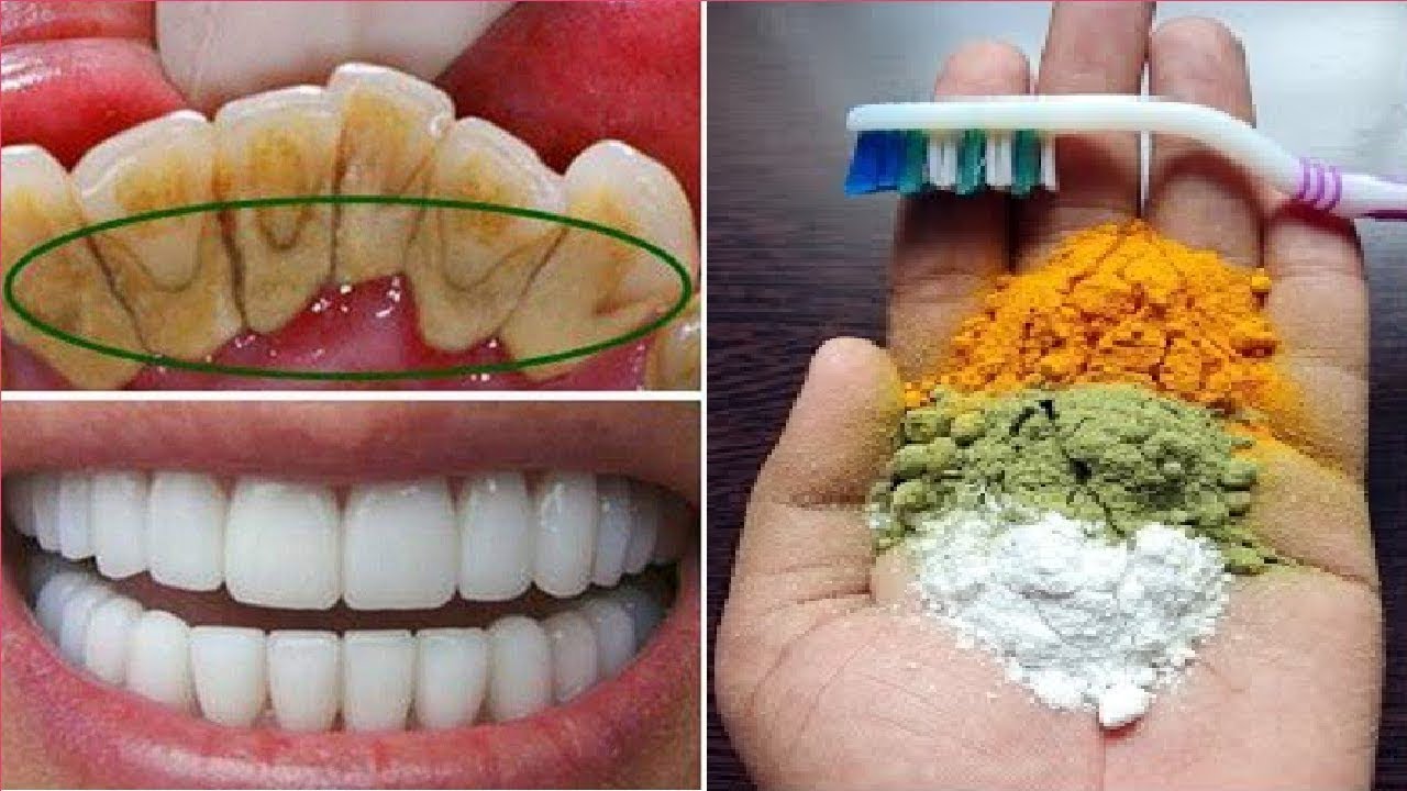 للون الثلج.. طريقة تبييض الأسنان في يوم واحد بمكون بسيط من مطبخك ووداعاً لطبيب الأسنان