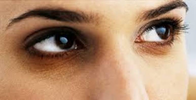 طريقة العلاج سريعا من الهالات السوداء بمكون طبيعي يخلصك من التجاعيد حول العين والترهل
