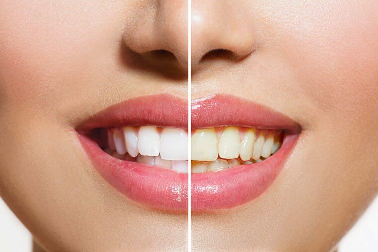 تبييض الأسنان في المنزل بوصفات طبيعية سهلة لتحصل على أسنان كاللؤلؤ بدون جير أو تصبغات