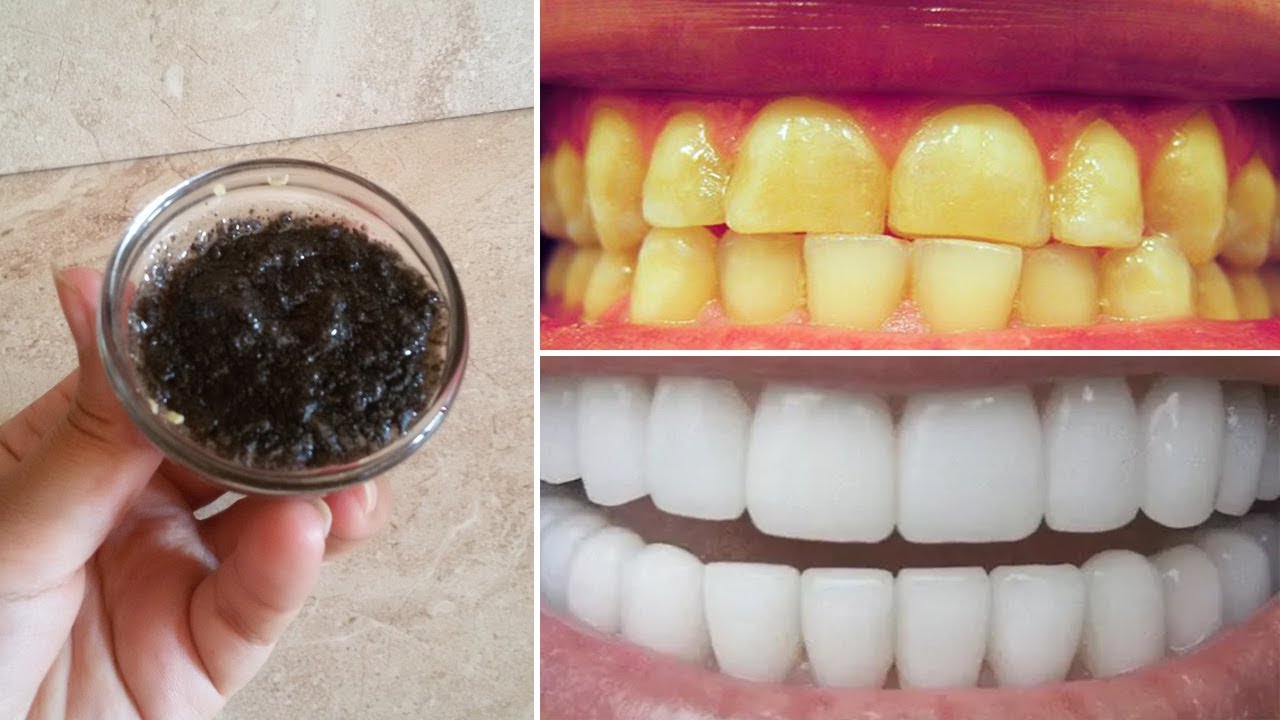انقذ أسنانك من الضياع.. طريقة سحرية لتبييض الأسنان بمكونات منزلية بسيطة ونتائج فورية مذهلة
