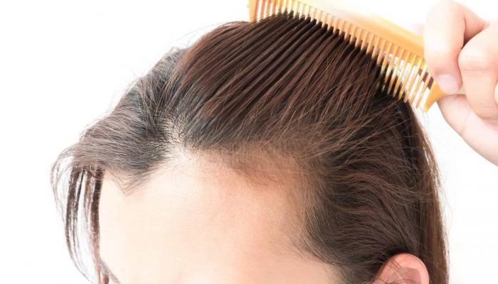 علاج سقوط الشعر
