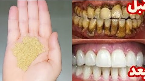 تبيض الأسنان بالبيكنج بودر خلال دقيقتين فقط وصفة سحرية منزلية صحية لجعل الأسنان اكثر بياضا