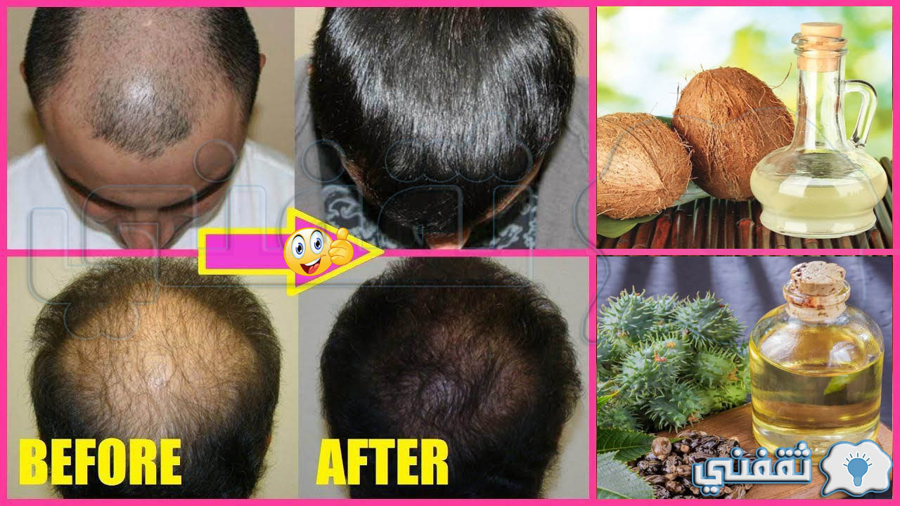 وداعاً للإحراج.. علاج فراغات الشعر في مقدمة الرأس بطرق طبيعية سينمو شعرك مرة أخرى والنتيجة روعة