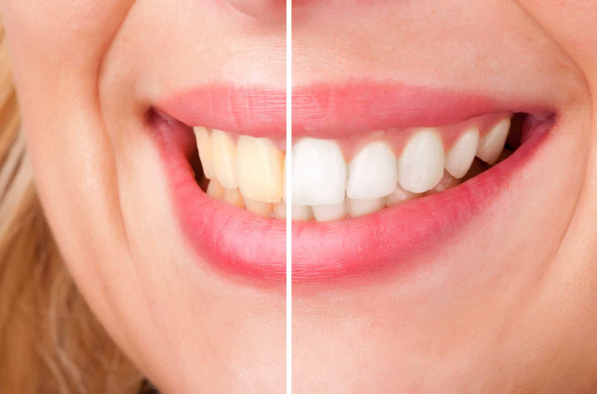 اقوى الوصفات السحرية الطبيعية لتبييض الاسنان في المنزل