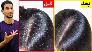 وصفة منزلية خارقة للقضاء على قشرة الشعر نهائيا وزيادة طول شعرك